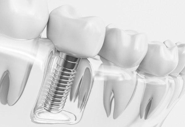 تانتالم و مشتقات آن در ایمپلنت های ارتوپدی و دندانی
